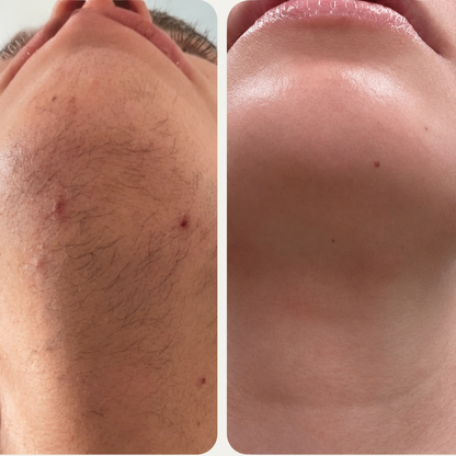 Smooth Skin Epilator