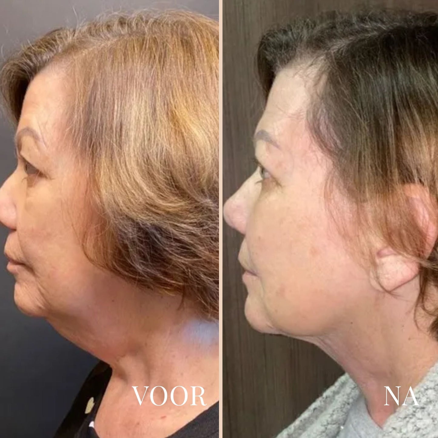 Lina Lift Nek en Oog Versterker Creme