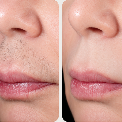 Smooth Skin Epilator